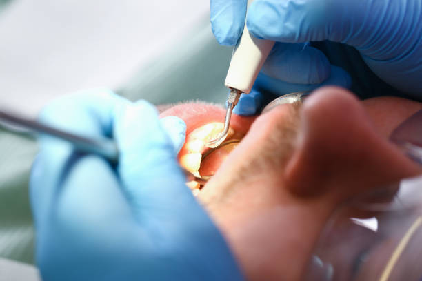 Best Emergency Treatment for Dental Infections or Abscesses in Wantagh, NY
