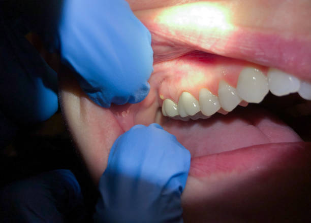 Best Emergency Dental Care for Broken or Chipped Teeth in Wantagh, NY