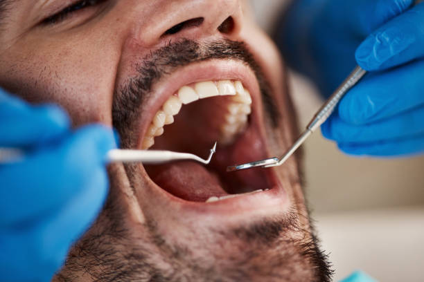 Best Emergency Dental Care for Broken or Chipped Teeth in Wantagh, NY